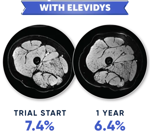 MRI with ELEVIDYS