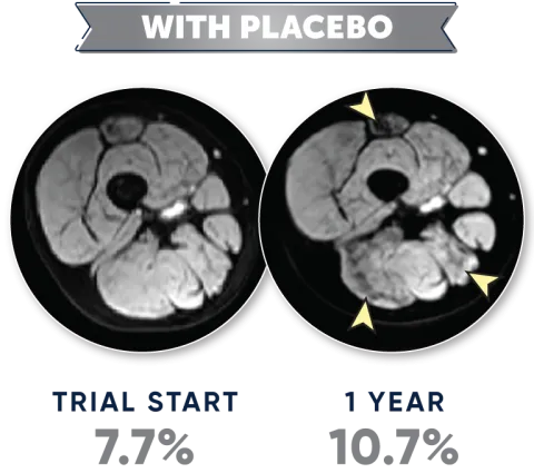 MRI with placebo